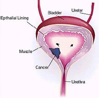 Bladder Cancer Treatment