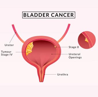 Bladder Cancer Treatment