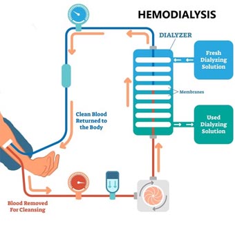 Dialysis Treatment