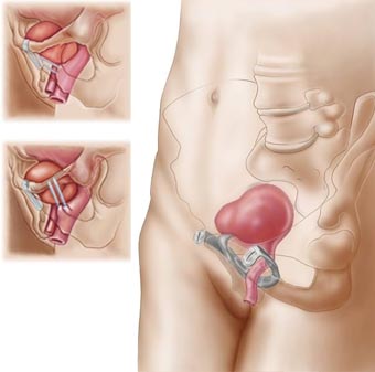 Female Incontinence Surgery