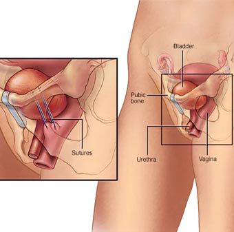 Female Incontinence Surgery