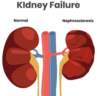 Kidney Failure Treatment