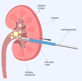 RIRS MINI MICRO PCNL Treatment